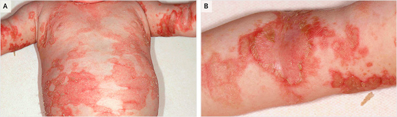 Çinko Eksikliğine Bağlı Egzema 