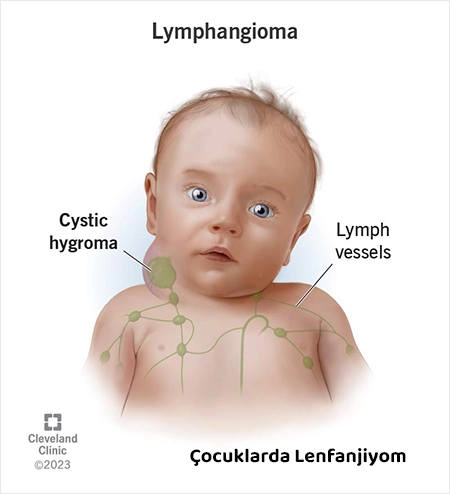 Çocuklarda Lenfanjiom