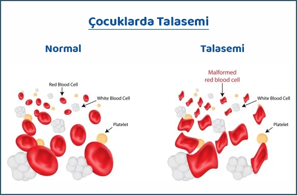 Çocuklarda Talasemi (Akdeniz Anemisi)
