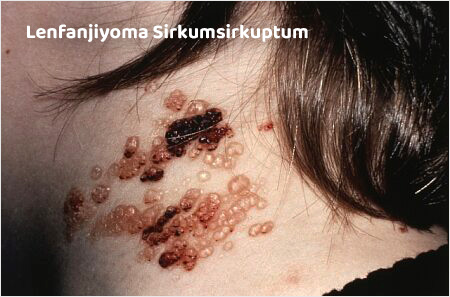 Lenfanjiyoma Sirkumsirkuptum