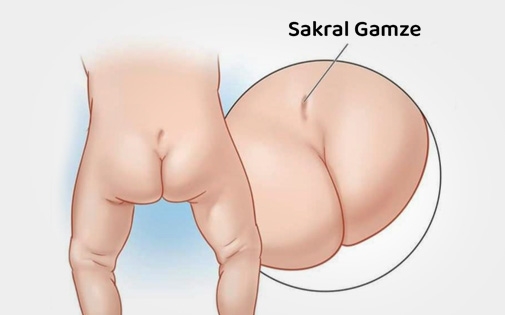 Sakral Gamze: Kuyruk Sokumunda Çöküntü, Çukur